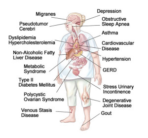 Obesity Related Illnesses (Comorbidities) - Bariatrix Florida